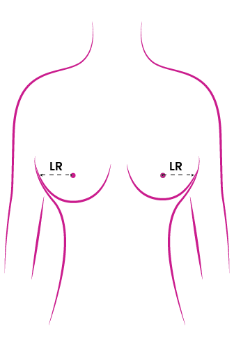 Lateral Breast Radius